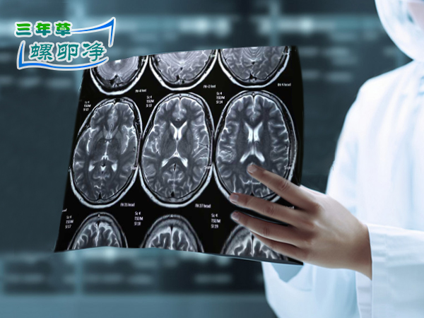感染广州软圆线虫患者头颅影像显示出病灶白点